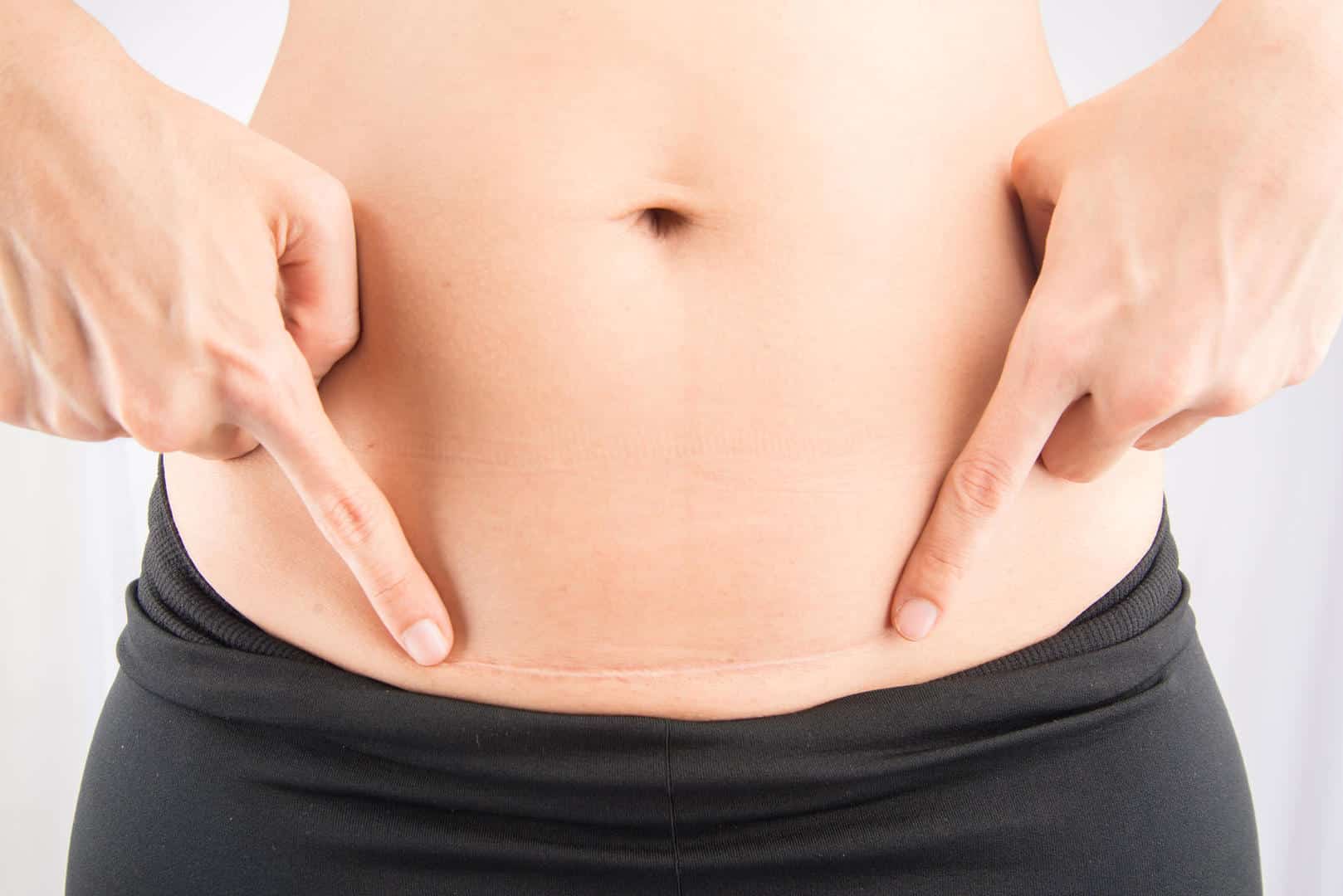 C-SECTION SCAR PHYSIOTHERAPY TREATMENT & REHABILITATION IN LONDON WITH OUR  WOMEN'S HEALTH PHYSIOTHERAPISTS, AT HOME OR AT THE PRACTICES IN BELGRAVIA,  CLAPHAM MONUMENT MOORGATE. C-SECTION SCAR MASSAGES & PAIN MANAGEMENT WITH  OUR
